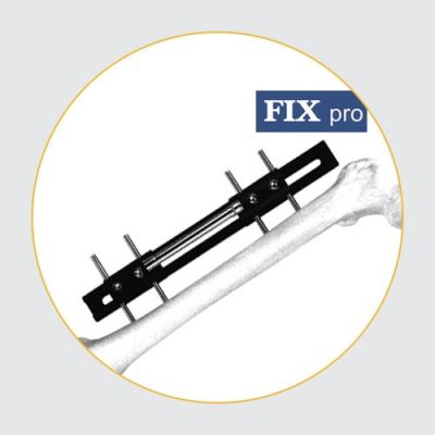 Bone Lengthening Fixators