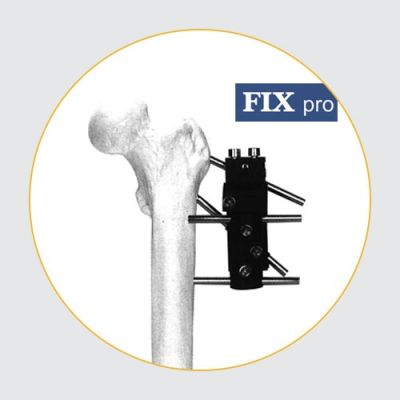 Joint Connecting Fixators