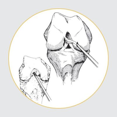 ACL/PCL Guide System